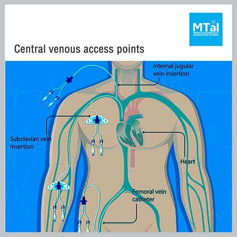 Central Venous Access