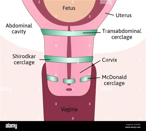 Cerclage Of The Cervix