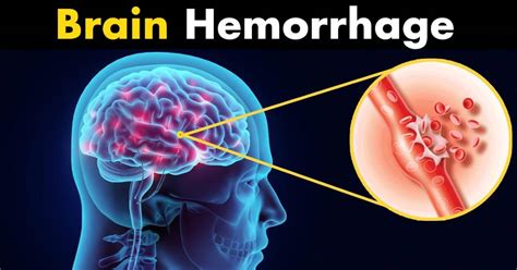 Cerebral Haemorrhage Recovery