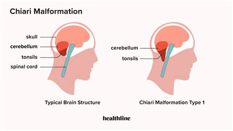 Cerebral Tonsils Low Lying