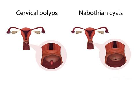 Cervical Polyp Pictures
