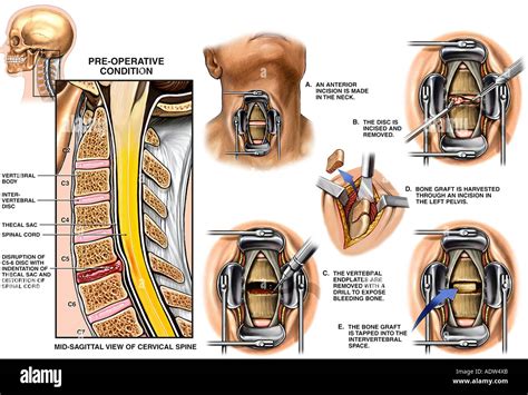 Cervical Spinal Fusion
