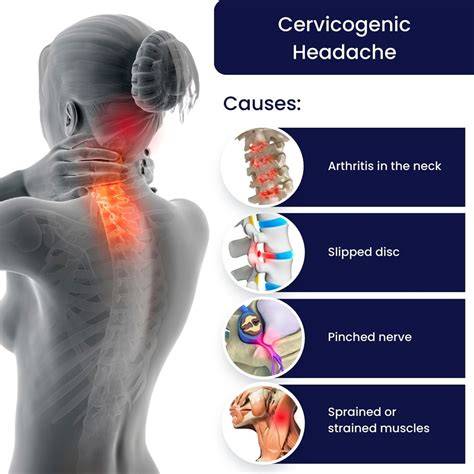 Cervicogenic Headache Symptoms
