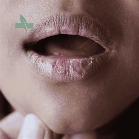 Chapped Lips Causes