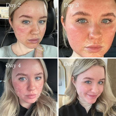 Chemical Peel And Facial