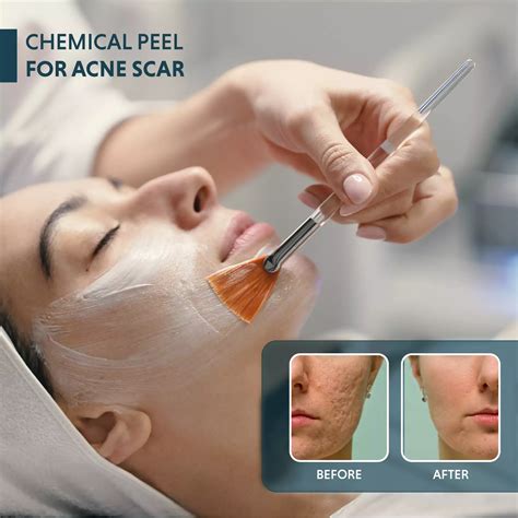 Chemical Peel For Pimples