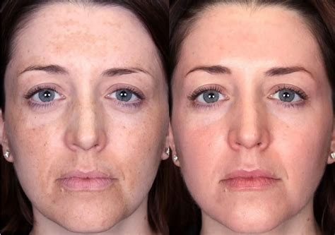 Chemical Peel With Glycolic Acid