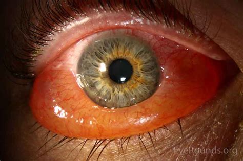 Chemosis Of The Eye