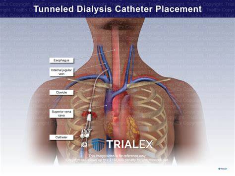 Chest Catheter For Dialysis
