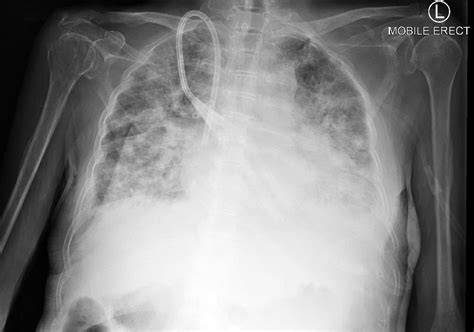 Chest X Ray Pulmonary Oedema