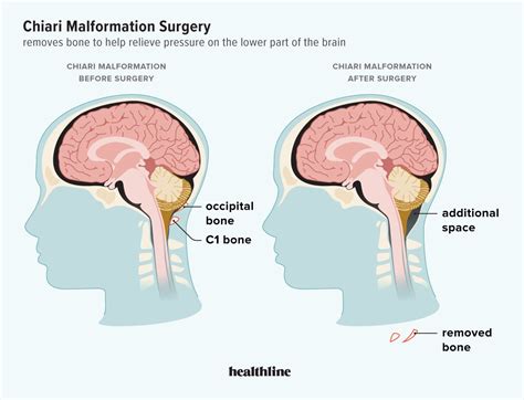 Chiari Malformation Treatment