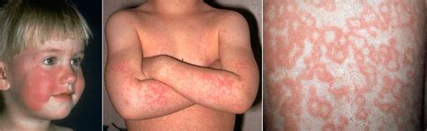 Childhood Fifth Disease