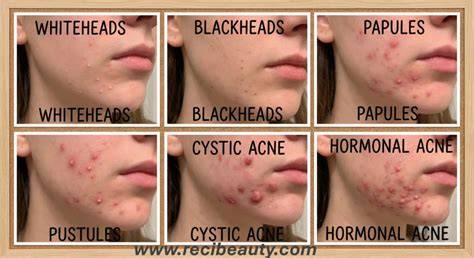 Chin Breakouts Meaning