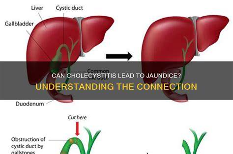 Cholecystitis Does It Cause Jaundice