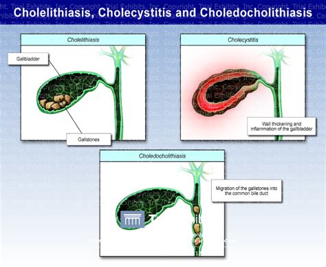 Cholecystitis Vs Cholecystolithiasis