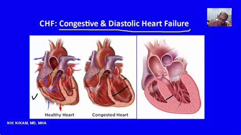 Chronic Diastolic Congestive Heart Failure