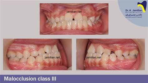 Class 3 Malocclusion