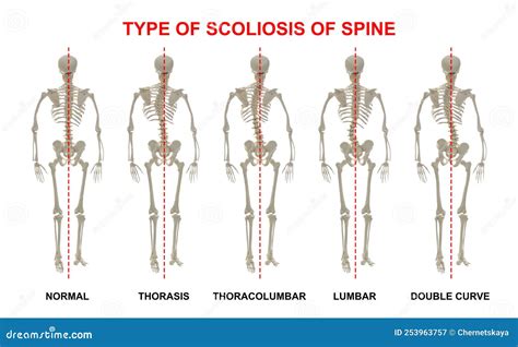 Classification Of Scoliosis