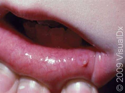 Clear Bump On Inside Lip
