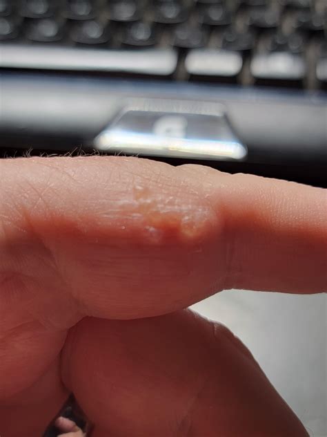 Clear Liquid From Spot