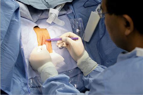 Clitoral Hood Reduction