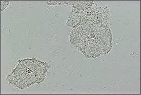 Clue Cells Wet Prep