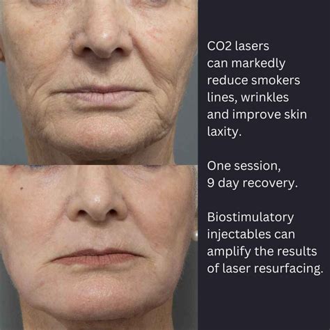 Co2 Laser Treatment