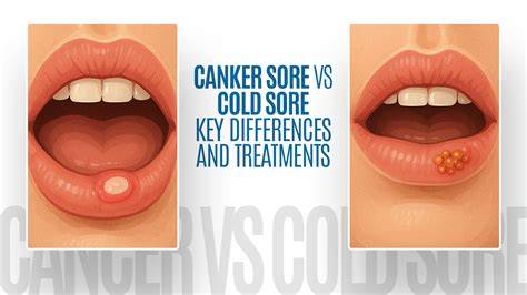 Cold Sore Versus Canker