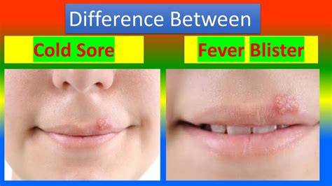 Cold Sore Vs Fever Blister