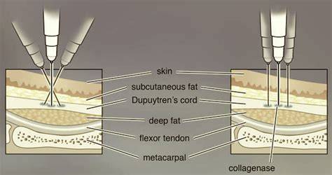 Collagenase Injection For Dupuytren