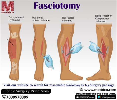 Compartment Syndrome Surgery