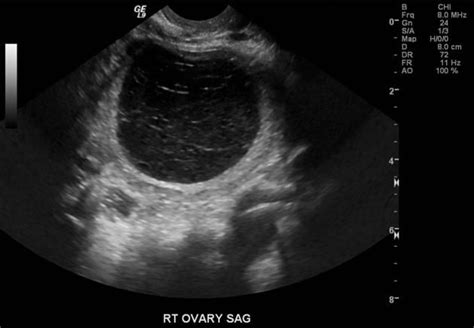 Complex Cyst On Ovary