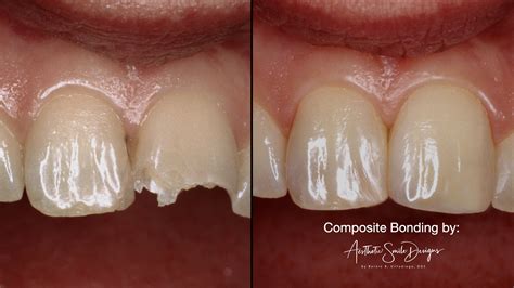 Composite Bonding Teeth