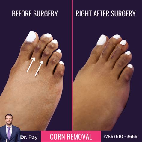 Corn Removal Surgery