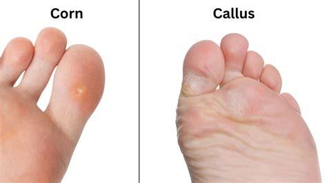 Corn Vs Callus