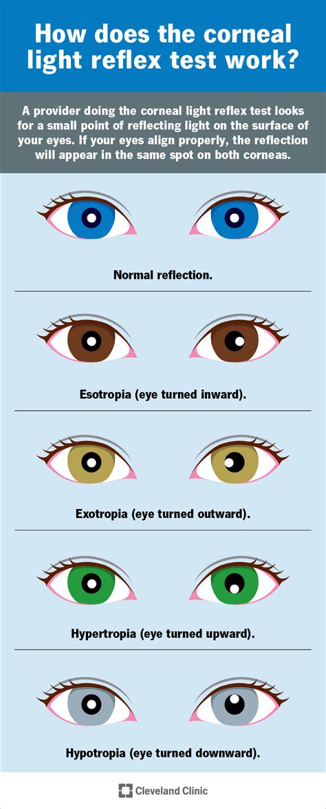 Corneal Light Reflex