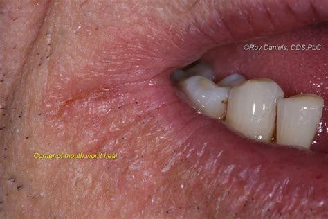 Corner Of Mouth Split