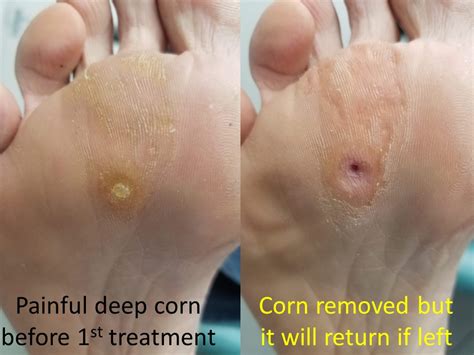 Corns On Feet Removal