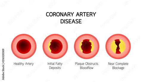 Coronary Artery Disease Stages