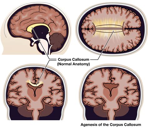 Corpus Callosum Agenesis