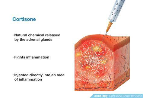 Cortisone Pimple Injection