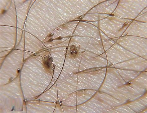 Crabs Pubic Lice Photos