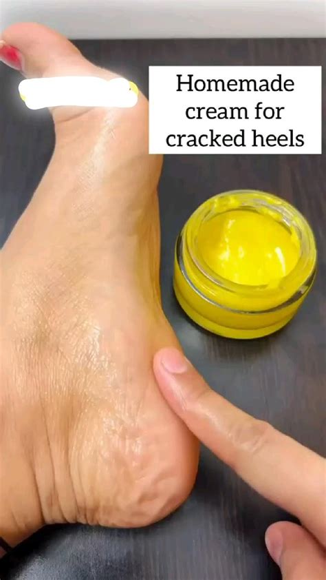 Cracked Heels Remedy