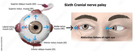 Cranial Nerve 6 Palsy
