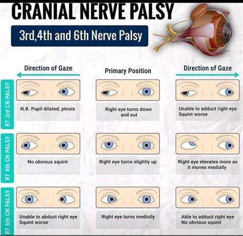 Cranial Nerve Palsies