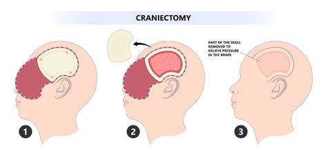Craniectomy Vs Craniotomy