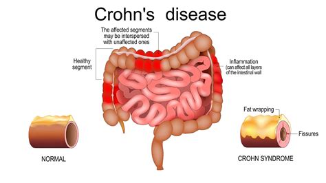 Crohn's Disease Selfcare
