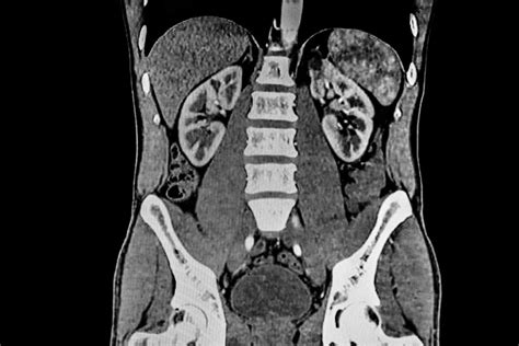 Ct Abdomen Pelvis