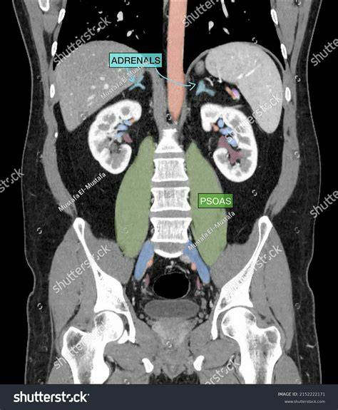 Ct Scan Abdomen And Pelvis
