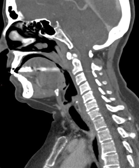 Ct Scan Of Neck